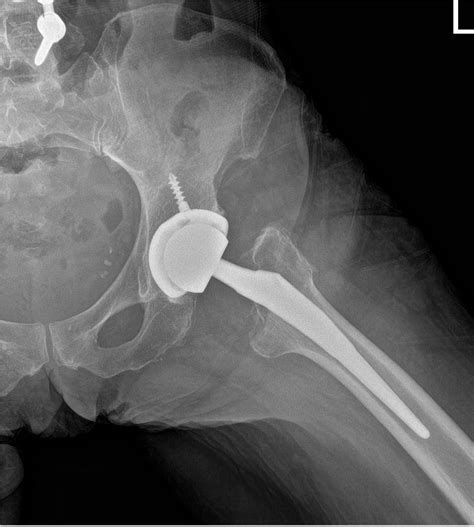 Case Study Bilateral Total Hip Replacement In Year Old