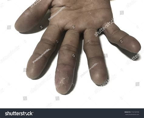 Diabetes Fingers Swelling at Connie Talbert blog