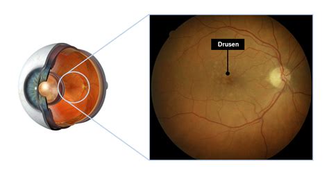 Macular Degeneration Eye Doctors Mona Vale