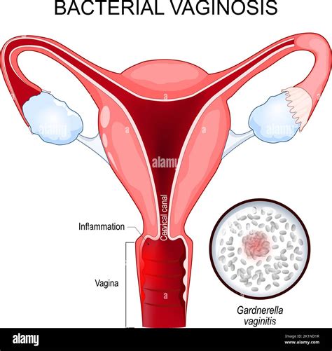 Bacterial Vaginosis Disease Of The Vagina Caused By Excessive Growth