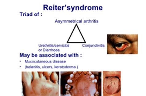 Reiter Disease