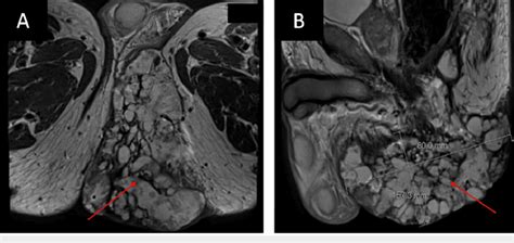 An Axial A And Sagittal B View Of The Pelvic Magnetic Resonance Download Scientific Diagram