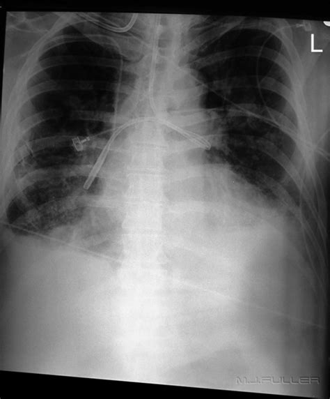 Correct Ng Tube Placement X Ray