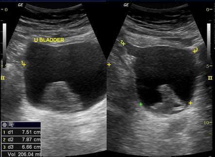 Findings Of Polypoid Lesion From Urinary Bladder Surgical Excision