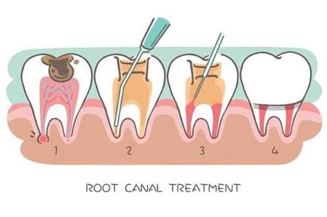 Guidelines That You Need To Follow For Root Canal Treatment Root Canal Treatment In Toronto