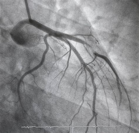 Coronary Artery Disease Orbusneich