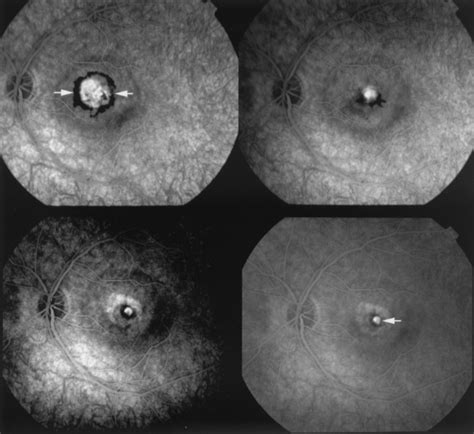 Treatment Of Idiopathic Subfoveal Choroidal Neovascular Lesions Using