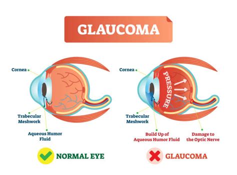 Glaucoma Illustrations Royalty Free Vector Graphics And Clip Art Istock