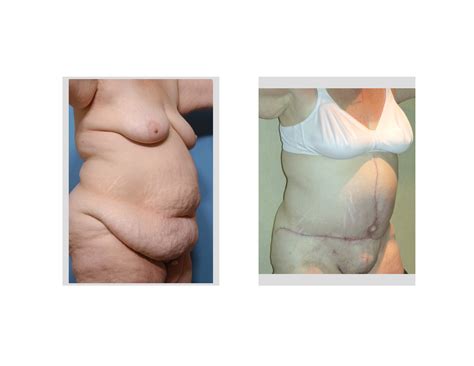 Fleur De Lis Tummy Tuck Dr Barry Eppley Indianapolis Explore Plastic