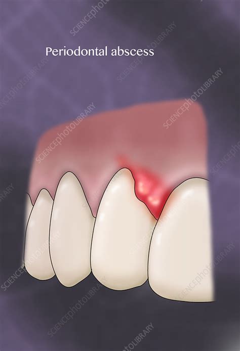 Lateral Periodontal Abscess