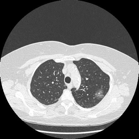 Adenocarcinoma In Situ Of Lung Radiology Case Radiopaedia Org