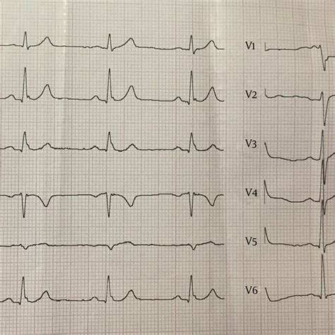 A 20 Year Old Male Whose Ecg Shows Erp Qrs Slurring In The Inferior Download Scientific