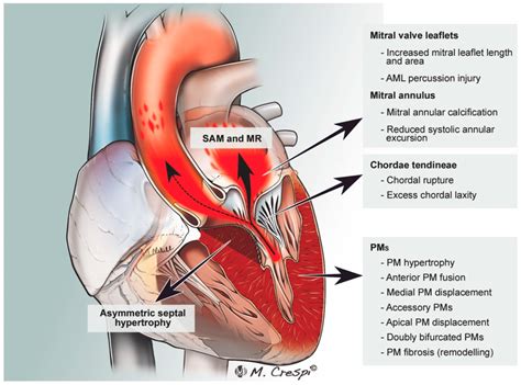 Pathophysiology Of Left Ventricle Outflow Tract Lvot Obstruction