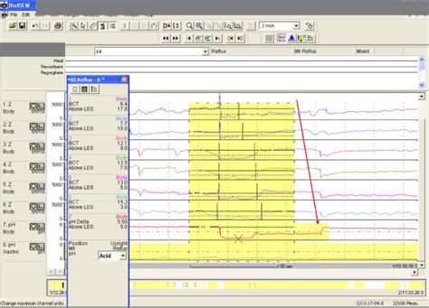 A Sige Singem Aigo Technical Review On The Clinical Use Of Esophageal