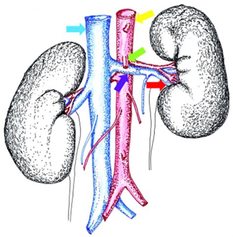 Varicocele And Nutcracker Syndrome Mohamadi 2010 Journal Of