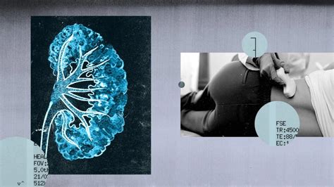 Spongy Kidney Syndrome At Laura Timbery Blog