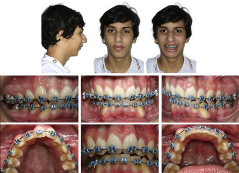 Orthodontic Surgical Treatment For A Patient With Class Ii Malocclusion And Inadequate Maxillary