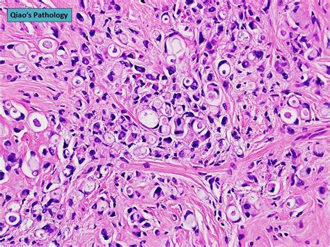 Flickriver Photoset Signet Ring Cell Variant Of Invasive Lobular