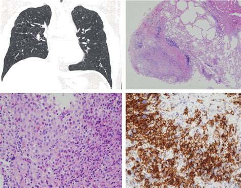 Pulmonary Langerhans Cell Histiocytosis A High Resolution Computed