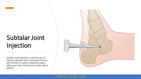 Subtalar Joint Injection OrthoFixar 2025