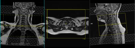 Brachial Plexus Mri Protocols Planning And Indications