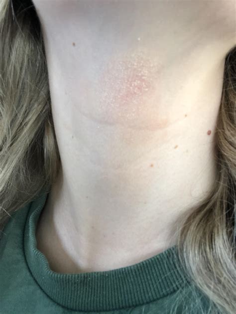 Rash On Neck Any Ideas Rskincareaddicts