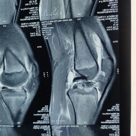 Acl Avulsion Fixation Through Pull Dr Jitendra Sarangi