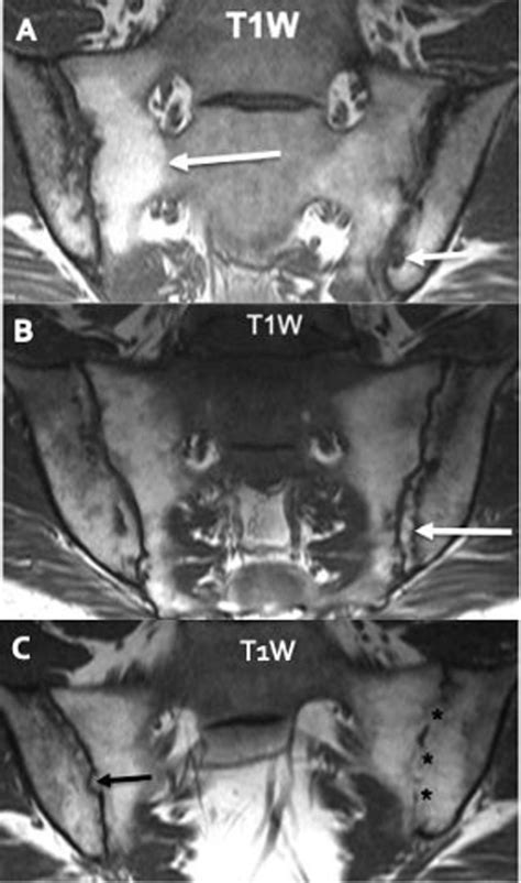 Mri Lesions In The Sacroiliac Joints Of Patients With Spondyloarthritis