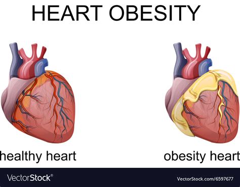 Obese Human Heart