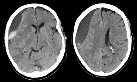 Subdural Hematom – Beyin Kanamaları – Doktor Fizik