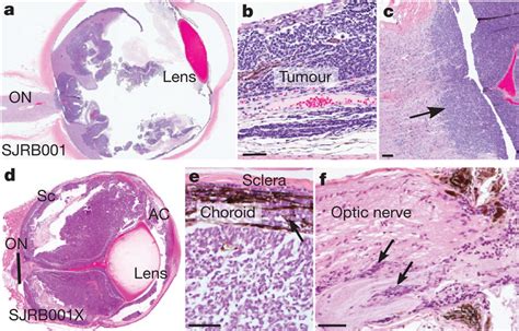 Characterization Of Retinoblastomas Samples A C Representative Download Scientific Diagram