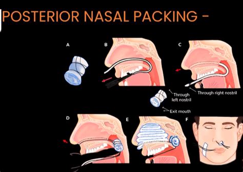 Epistaxis Causes And Management Prepladder