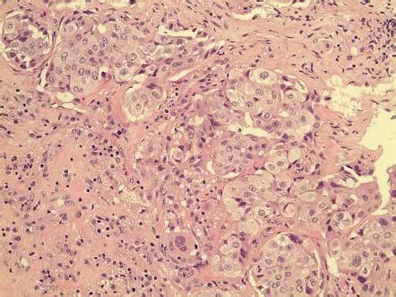 Pituitary Metastasis Image Radiopaedia Org