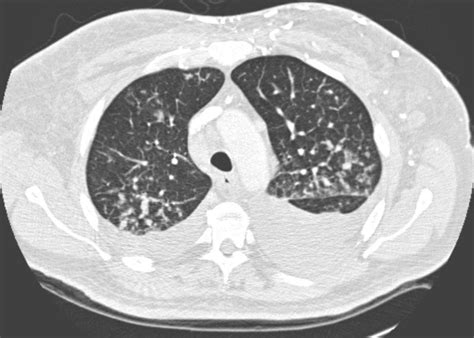 Axial Ct Of The Mid Thorax With Lung Window Settings Bilateral Pleural Download Scientific