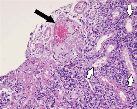 Kidney Superficial Renal Venules Necrotic Tubular Epithelial Cells