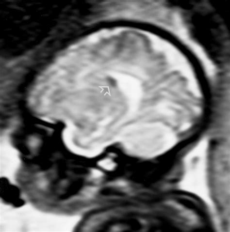 Tuberous Sclerosis In The Fetus Second Trimester Diagnosis Of Subependymal Tubers With Ultrafast