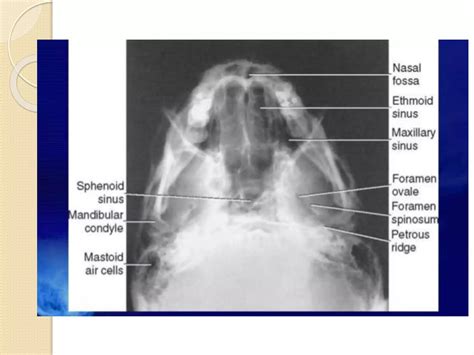 Radiology Of Nose And Paranasal Sinuses Ppt