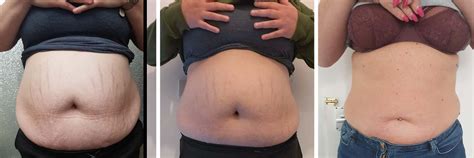 Liquid Lipo Fat Reduction Heswall Laser Clinic