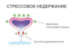 Недержание мочи у женщин – лечение в домашних условиях