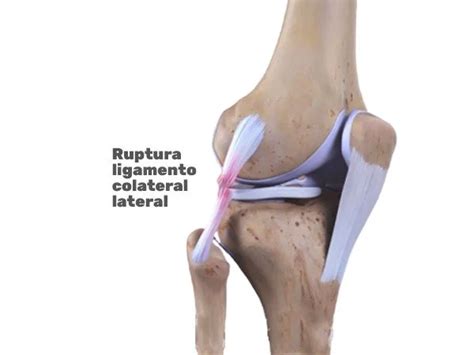 Ligamento Colateral Lateral