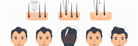 Guide To Fue Hair Transplant Benefits Process And Recovery