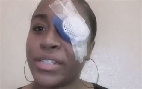 George Floyd: BLM protester shows rubber bullet injury that caused loss of vision - VIDEO ...