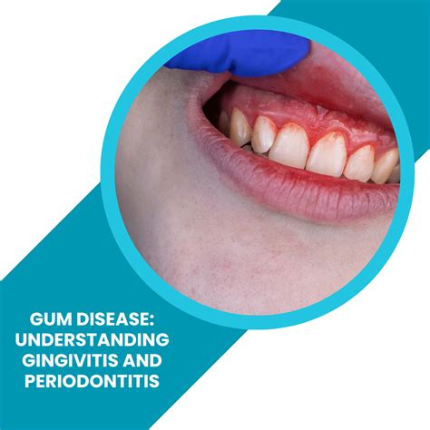 Gingivitis vs Periodontitis Cuál es la diferencia