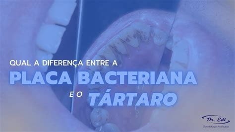 Placa Bacteriana X Tártaro saiba qual é a diferença entre um e o outro