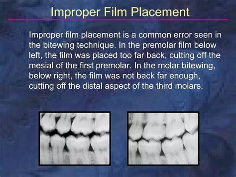 radiology-bitewing-technique | PPT