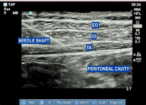 Sonographic Image Showing Insertion Of Sonotap Needle With The Needle