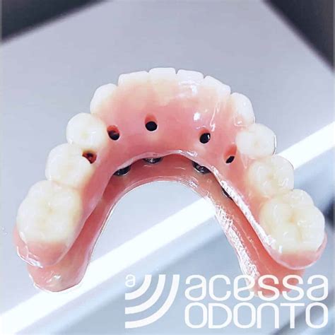 Protocolo De Implantes Em Carga Imediata Dentista Em Vargem Grande