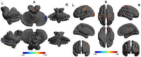 Frontiers Altered Regional Cortical Brain Activity In Healthy