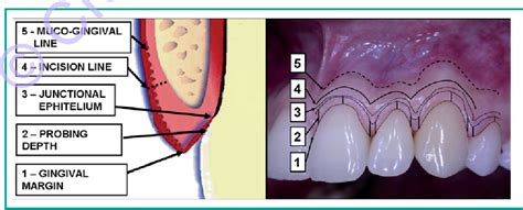 Figure 1 From The Ratio In Choosing Access Flap For Surgical