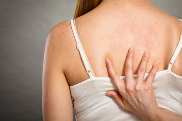 Orticaria Cause Rimedi Naturali Cure Contro Prurito Donna Moderna